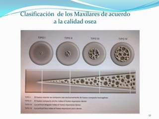 Clasificación de los Maxilares de acuerdo
             a la calidad osea




                                            52
 