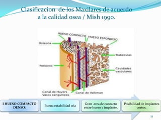 Clasificacion de los Maxilares de acuerdo
               a la calidad osea / Mish 1990.




I HUESO COMPACTO                             Gran area de contacto    Posibilidad de implantes
                   Buena estabilidad 1ria
      DENSO:                                entre hueso e implante.            cortos.

                                                                                        53
 