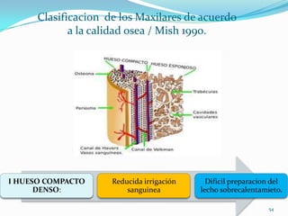 Clasificacion de los Maxilares de acuerdo
             a la calidad osea / Mish 1990.




I HUESO COMPACTO     Reducida irrigación     Dificil preparacion del
      DENSO:             sanguinea         lecho sobrecalentamieto.

                                                               54
 