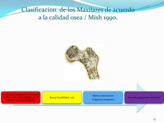 Clasificacion de los Maxilares de acuerdo
                  a la calidad osea / Mish 1990.




II HUESO COMPACTO DENSO                            Buena cicatrizacion
Y POROSO/ ESPONJOSO CON   Buena Estabilidad 1ria                          Sencilla preparacion del lecho
   TRABECULACIÓN DENSA                             Irrigacion sanguinea




                                                                                                 55
 