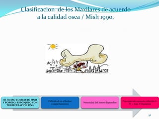 Clasificacion de los Maxilares de acuerdo
                  a la calidad osea / Mish 1990.




III HUESO COMPACTO FINO
                          Dificultad en el lecho/                                    Poca área de contacto relación I–
Y POROSO/ ESPONJOSO CON                             Necesidad del hueso disponible
                             ensanchamiento                                               H = mas # Implantes
    TRABECULACIÓN FINA



                                                                                                             56
 