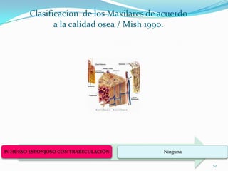 Clasificacion de los Maxilares de acuerdo
               a la calidad osea / Mish 1990.




IV HUESO ESPONJOSO CON TRABECULACIÓN      Ninguna

                                                    57
 