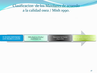 Clasificacion de los Maxilares de acuerdo
                 a la calidad osea / Mish 1990.




IV HUESO ESPONJOSO   Dificultad en el lecho/   Necesidad del hueso   Poca área de contacto relación
CON TRABECULACIÓN        estabilidad 1ria          disponible          I– H = mas # Implantes




                                                                                            58
 
