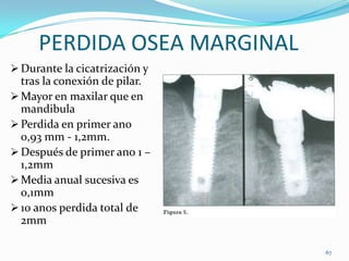 PERDIDA OSEA MARGINAL
 Durante la cicatrización y
  tras la conexión de pilar.
 Mayor en maxilar que en
  mandibula
 Perdida en primer ano
  0,93 mm - 1,2mm.
 Después de primer ano 1 –
  1,2mm
 Media anual sucesiva es
  0,1mm
 10 anos perdida total de
  2mm

                               67
 