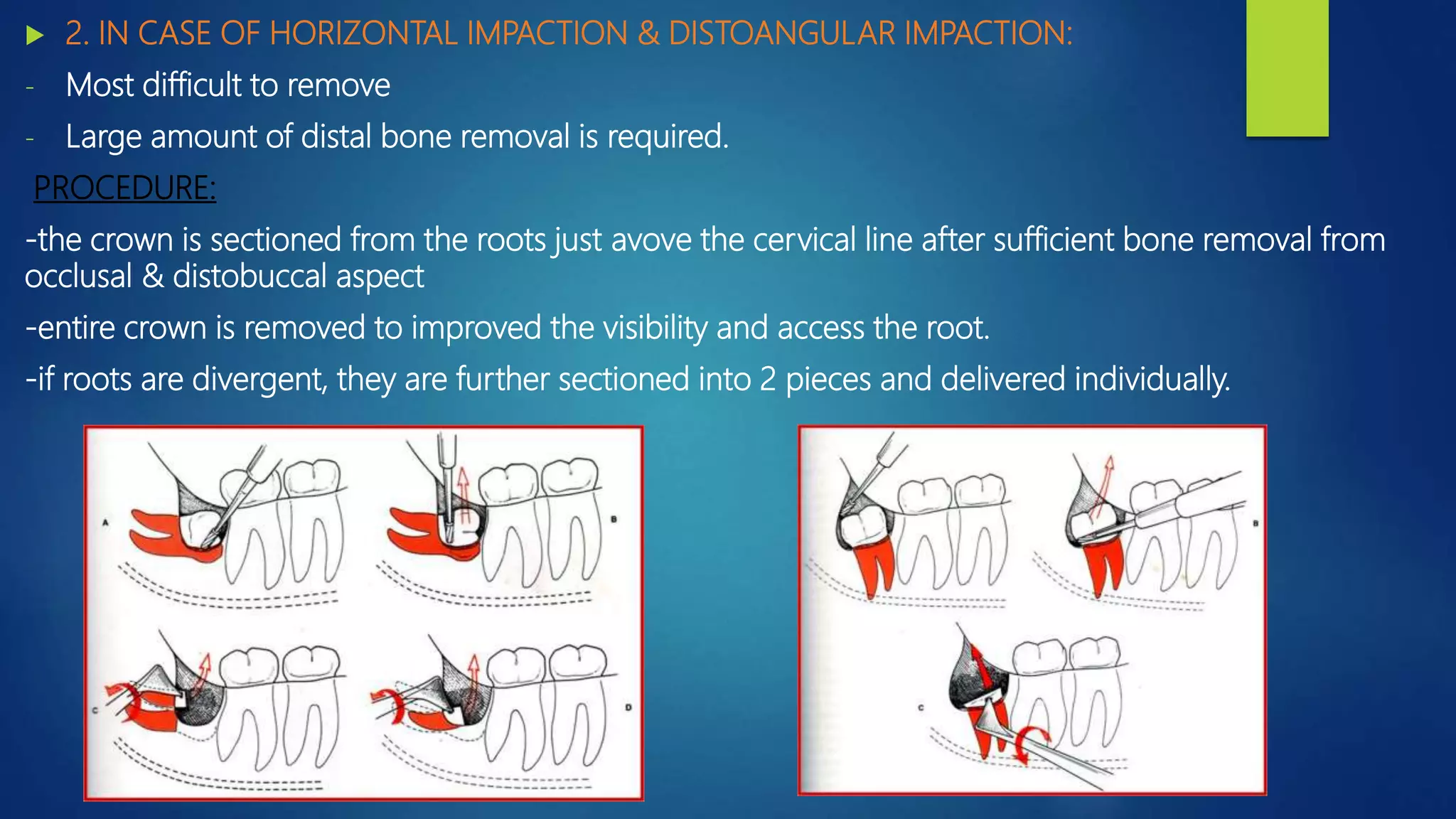 Mandibular 3rd molar impacion | PPTX