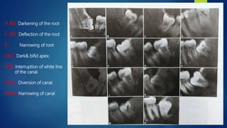 A &B: Darkening of the root
C &D: Deflection of the root
E: Narrowing of root
F&G: Dark& bifid apex.
H&I: Interruption of white line
of the canal.
J,K&L: Diversion of canal.
M&N: Narrowing of canal
 