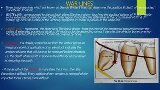  Three imaginary lines which are known as George Winter’s lines can determine the position & depth of the impacted
mandibular 3rd molar.
1. WHITE LINE- corresponsed to the occlusal plane.The line is drawn touching the occlusal sufaces of 1st & 2nd molar
and is extended posteriorly over the 3rd molar region.It indicates the difference in the occlusal level of 2nd & 3rd
molars. eg: occlusal surface of the vertically impacted 3rd molar is parallel to the white line.
2. AMBER LINE – represents the bone level.The line is drawn from the crest of the interdental septum between the
molars & extended posteriorly distal to 3rd molar or to the ascending ramus.It denotes the alveolar bone covering
the impacted tooth& portion of tooth not covered by bone.
3. RED LINE- It is drawn perpendicular from the amber line to an
Imaginary point of application of an elevator.It indicates the
amount of bone that will have to be removed before elevation,
i.e. the depth of the tooth in bone & the difficulty encountered
in removing the tooth.
- If the length of the red line is more than the 5 mm, then the
Extraction is difficult. Every additional mm renders to removal of the
impacted tooth 3 times more difficult
WAR LINES
 