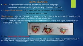 BONE REMOVAL
 AIM: -To expose/uncover the crown by removing the bone overlying it.
-To remove the bone obstructing the pathway for removal of a tooth.
 2 ways of Bone removal: 1. High speed,high torque handpiece&bur technique
2.Chisel & mallet technique.
1.Bur technique: Either no. 7/8 round bur or a straight no. 702 or 703 carbide bus is used. Bur should be used
along with copious saline irrigation to avoid thermal trauma to the bone.
 1st step: the bur is used in a sweeping motion around the occlusal, buccal& distal aspect of mandibular 3rd
molar crown to expose it.
2nd Step: (Moore Gillbe Collar technique);
once the tooth crown is located ,the buccal suface of the tooth is exposed with the bur to the cervical level of
the crown contour & a buccal trough or gutter/ collar (made in cancellous bone)is created.
 