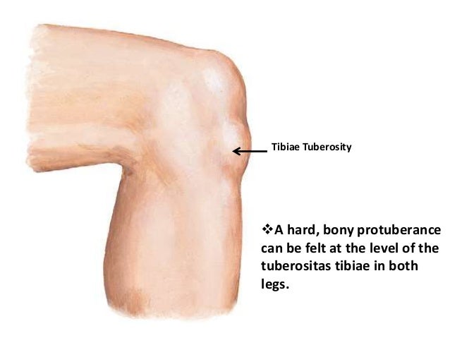 Osgood Schlatter Disease osgood-schlatter-disease