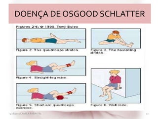 DOENÇA DE OSGOOD SCHLATTER
3/28/2011 CAMILA RABAY-R1 21
 