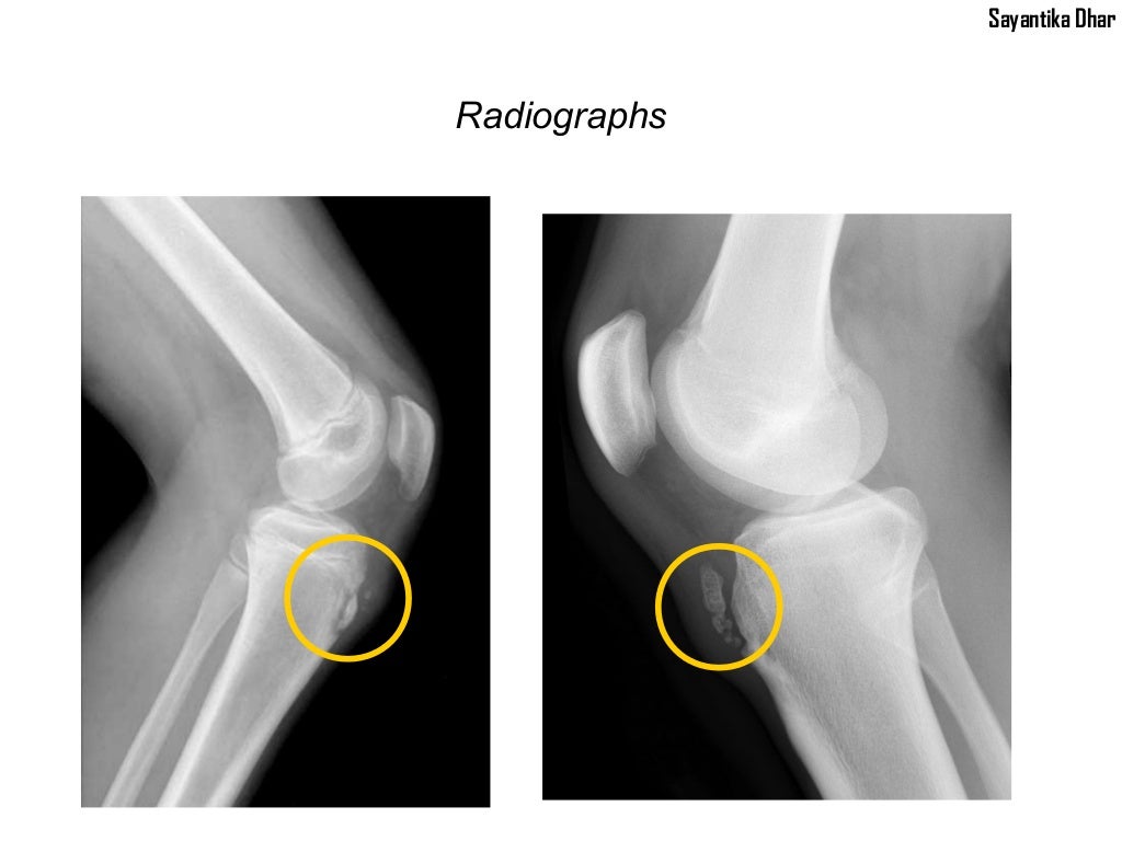 Osgood Schlatter Disease