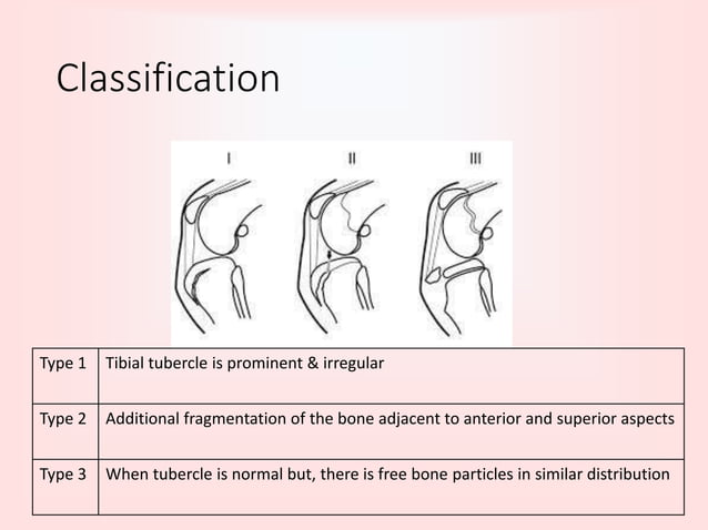Osgood schlatter disease | PPTX