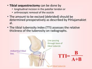 Osgood schlatter disease | PPTX