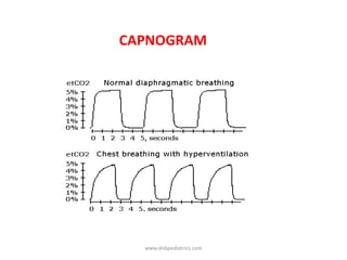 CAPNOGRAM
www.dnbpediatrics.com
 