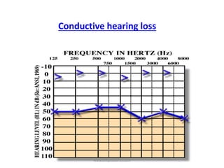 Conductive hearing loss
www.dnbpediatrics.com
 
