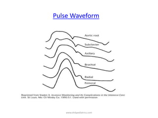 Pulse Waveform
www.dnbpediatrics.com
 