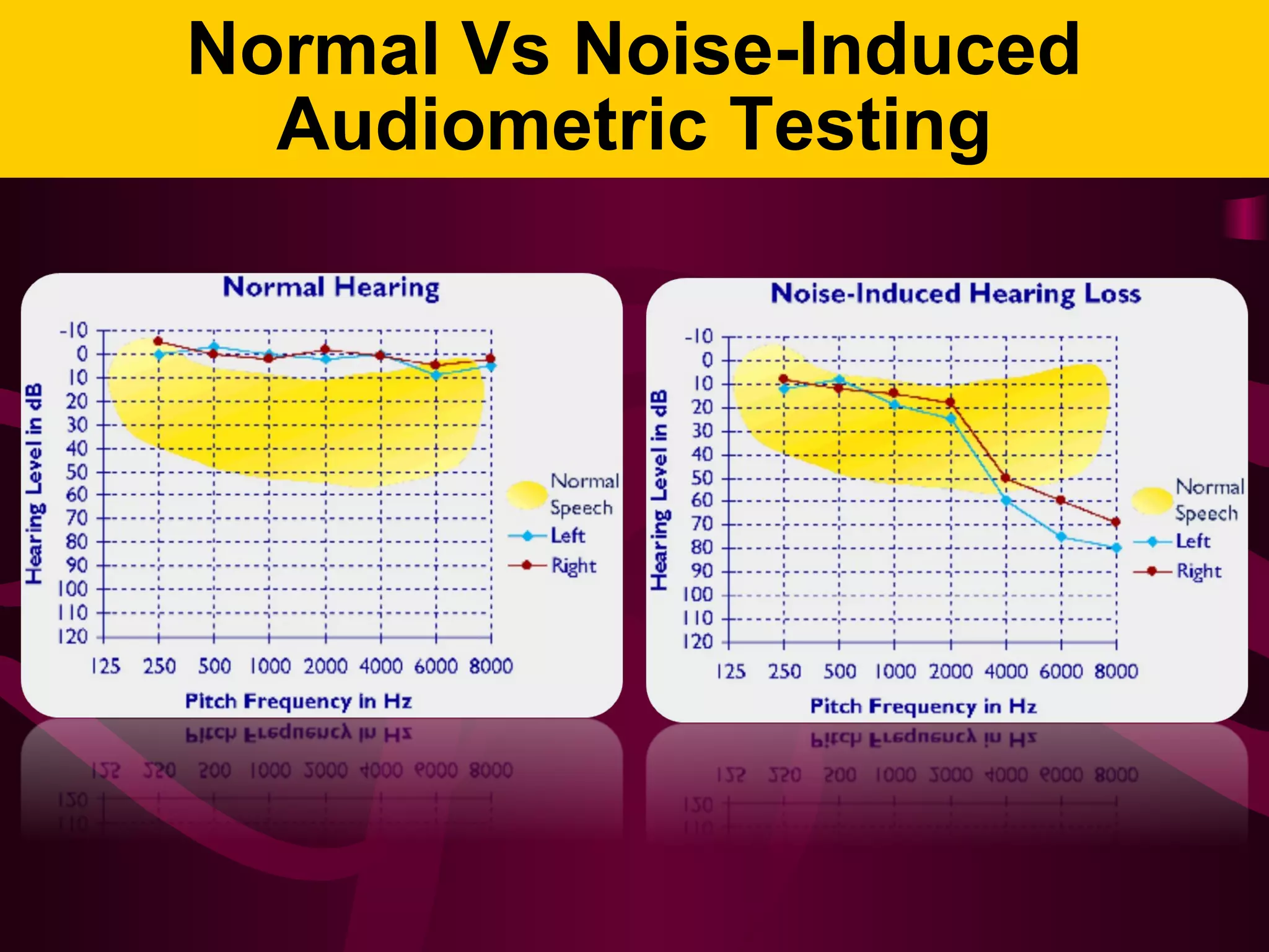 Normal Vs Noise-Induced
Audiometric Testing
 