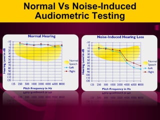 Normal Vs Noise-Induced
Audiometric Testing
 