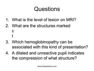 Questions
1. What is the level of lesion on MRI?
2. What are the structures marked
c
t
3. Which hemoglobinopathy can be
associated with this kind of presentation?
4. A dilated and unreactive pupil indicates
the compression of what structure?
www.dnbpediatrics.com
 