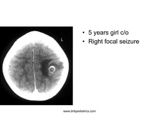 • 5 years girl c/o
• Right focal seizureL
www.dnbpediatrics.com
 