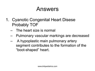 Answers
1. Cyanotic Congenital Heart Disese
Probably TOF
– The heart size is normal
– Pulmonary vascular markings are decreased
– A hypoplastic main pulmonary artery
segment contributes to the formation of the
“boot-shaped” heart.
1.5
Pediatric cardiology
Myung K Park 5th ed
www.dnbpediatrics.com
 