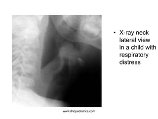 • X-ray neck
lateral view
in a child with
respiratory
distress
www.dnbpediatrics.com
 