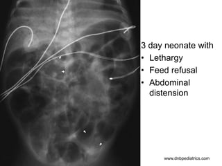 3 day neonate with
• Lethargy
• Feed refusal
• Abdominal
distension
www.dnbpediatrics.com
 