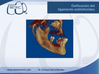 www.dentometric.com Dr. Enrique Sierra Rosales
Osificación del
ligamento estilohioideo
 