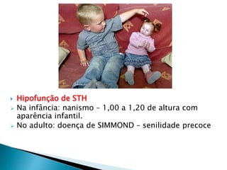  Hipofunção de STH
 Na infância: nanismo – 1,00 a 1,20 de altura com
aparência infantil.
 No adulto: doença de SIMMOND – senilidade precoce
 