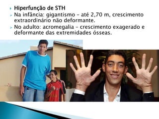  Hiperfunção de STH
 Na infância: gigantismo – até 2,70 m, crescimento
extraordinário não deformante.
 No adulto: acromegalia – crescimento exagerado e
deformante das extremidades ósseas.
 