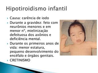  Causa: carência de iodo
 Durante a gravidez: feto com
neurônios menores e em
menor nº, mielinização
defeituosa dos axônios e
deficiência mental.
 Durante os primeiros anos de
vida: menor estatura,
pequeno desenvolvimento do
encéfalo e órgãos genitais.
 CRETINISMO
 