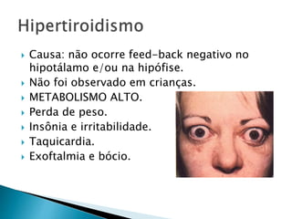  Causa: não ocorre feed-back negativo no
hipotálamo e/ou na hipófise.
 Não foi observado em crianças.
 METABOLISMO ALTO.
 Perda de peso.
 Insônia e irritabilidade.
 Taquicardia.
 Exoftalmia e bócio.
 