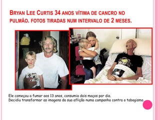 BRYAN LEE CURTIS 34 ANOS VÍTIMA DE CANCRO NO
PULMÃO. FOTOS TIRADAS NUM INTERVALO DE 2 MESES.
Ele começou a fumar aos 13 anos, consumia dois maços por dia.
Decidiu transformar as imagens da sua aflição numa campanha contra o tabagismo.
 