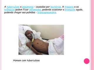 A tuberculose e pneumonia - causadas por bactérias. A traqueia e os
brônquios podem ficar inflamados, podendo ocasionar a bronquite aguda,
podendo chegar aos pulmões - broncopneumonia.
Homem com tuberculose
 