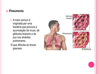  Pneumonia
 A mais comum é
originada por uma
bactéria que provoca a
acumulação de muco, de
glóbulos brancos e de
pus nos alvéolos
pulmonares.
O que dificulta as trocas
gasosas.
 