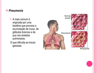 Pneumonia A mais comum é originada por uma bactéria que provoca a acumulação de muco, de glóbulos brancos e de pus nos alvéolos pulmonares. O que dificulta as trocas gasosas. 