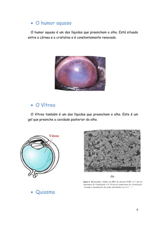 • O humor aquoso
 O humor aquoso é um dos líquidos que preenchem o olho. Está situado
entre a córnea e o cristalino e é constantemente renovado.




 • O Vítreo
 O Vítreo também é um dos líquidos que preenchem o olho. Este é um
gel que preenche a cavidade posterior do olho.




 • Quiasma


                                                                   9
 