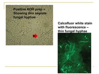 Positive KOH prep
Showing thin septate
fungal hyphae
Calcofluor white stain
with fluorescence –
thin fungal hyphae
 