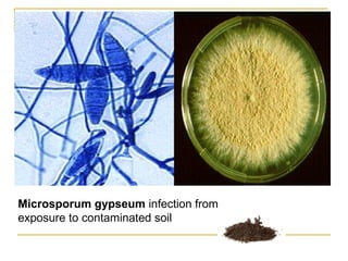 Microsporum gypseum infection from
exposure to contaminated soil
 