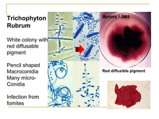 Trichophyton
Rubrum
White colony with
red diffusable
pigment
Pencil shaped
Macroconidia
Many micro-
Conidia
Infection from
fomites
Red diffusible pigment
 