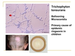 Trichophyton
tonsurans
Ballooning
Microconidia
Primary cause of
epidemic
ringworm in
children
 