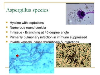 Aspergillus species
 Hyaline with septations
 Numerous round conidia
 In tissue - Branching at 45 degree angle
 Primarily pulmonary infection in immune suppressed
 Invade vessels, cause thrombosis & infarctions
 