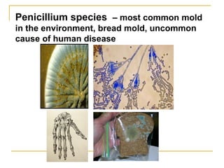 Penicillium species – most common mold
in the environment, bread mold, uncommon
cause of human disease
 