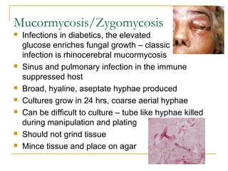 Mucormycosis/Zygomycosis
 Infections in diabetics, the elevated
glucose enriches fungal growth – classic
infection is rhinocerebral mucormycosis
 Sinus and pulmonary infection in the immune
suppressed host
 Broad, hyaline, aseptate hyphae produced
 Cultures grow in 24 hrs, coarse aerial hyphae
 Can be difficult to culture – tube like hyphae killed
during manipulation and plating
 Should not grind tissue
 Mince tissue and place on agar
 