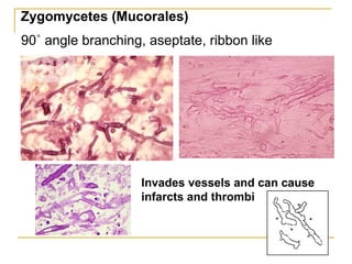 90˚ angle branching, aseptate, ribbon like
Invades vessels and can cause
infarcts and thrombi
Zygomycetes (Mucorales)
 
