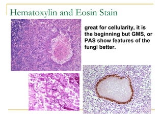 great for cellularity, it is
the beginning but GMS, or
PAS show features of the
fungi better.
Hematoxylin and Eosin Stain
 