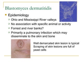 Blastomyces dermatitidis
 Epidemiology
 Ohio and Mississippi River valleys
 No association with specific animal or activity
 Forrest and river banks?
 Primarily a pulmonary infection which may
disseminate to the skin and bone
Well demarcated skin lesion is typical
Scraping of skin lesions are full of
yeast cells
 