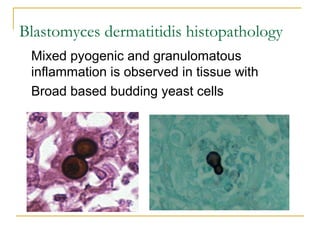 Blastomyces dermatitidis histopathology
Mixed pyogenic and granulomatous
inflammation is observed in tissue with
Broad based budding yeast cells
 