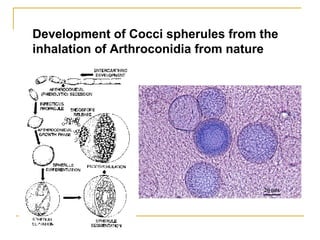 Development of Cocci spherules from the
inhalation of Arthroconidia from nature
 