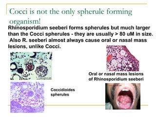 Rhinosporidium seeberi forms spherules but much larger
than the Cocci spherules - they are usually > 80 uM in size.
Also R. seeberi almost always cause oral or nasal mass
lesions, unlike Cocci.
Oral or nasal mass lesions
of Rhinosporidium seeberi
Coccidioides
spherules
Cocci is not the only spherule forming
organism!
 